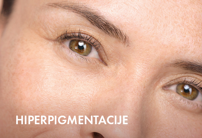 Hiperpigmentacije
