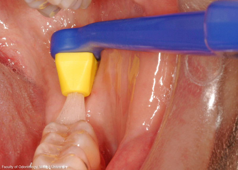 TePe Interspace Soft, zobna ščetka s 4 nastavki