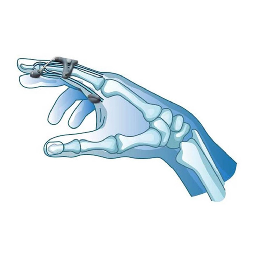 Prim PSL180, iztegovalnik prstov - različne velikosti (1 kos)