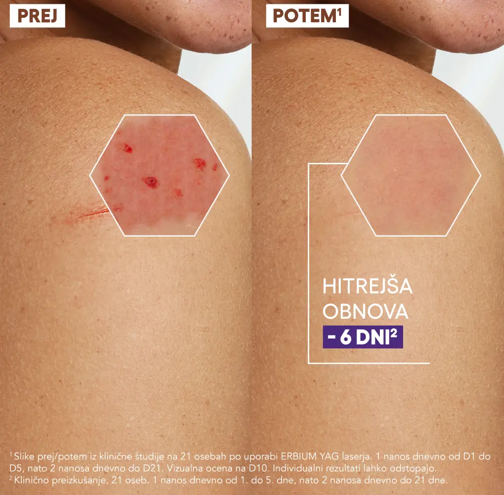 A-Derma Epithelial Ultra Repair, obnavljajoča krema proti sledem (40 ml)