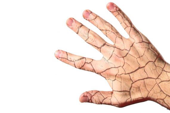 Atopijski dermatitis: Uzroci, simptomi i liječenje